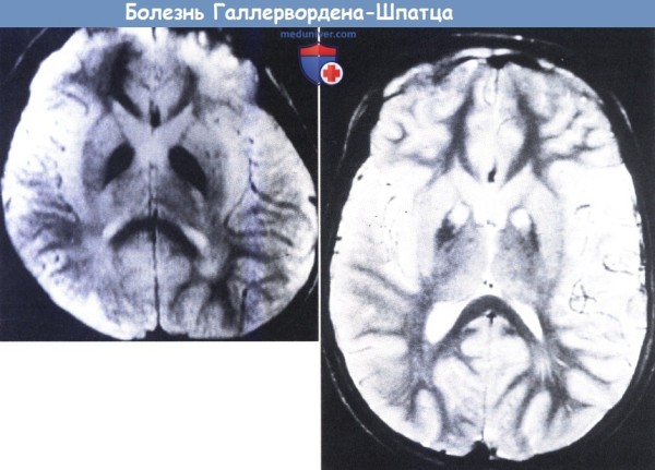 Нейродегенерация Галлервордена-Шпатца — симптомы, лечение, прогноз