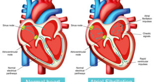Доказана высокая частота сердечной недостаточности при бессимптомной фибрилляции предсердий