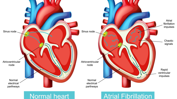 Доказана высокая частота сердечной недостаточности при бессимптомной фибрилляции предсердий