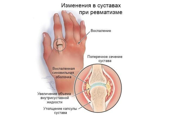 Иерсиниоз &mdash; причины, симптомы, лечение