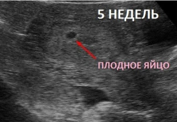 Анэхогенное включение в матке &mdash; причины и последствия