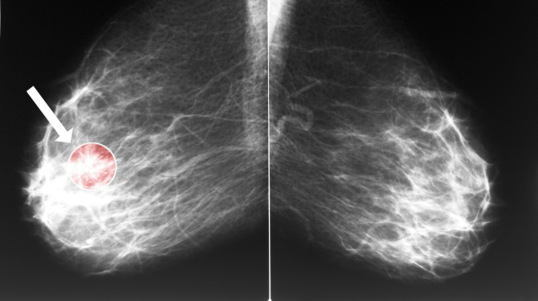 Профилактическая мастэктомия не повышала выживаемость у носителей мутаций гена BRCA