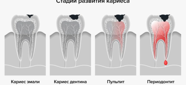 Ноющая зубная боль — причины и лечение Ноющая зубная боль — причины и лечение