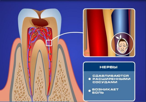 Ноющая зубная боль — причины и лечение Ноющая зубная боль — причины и лечение