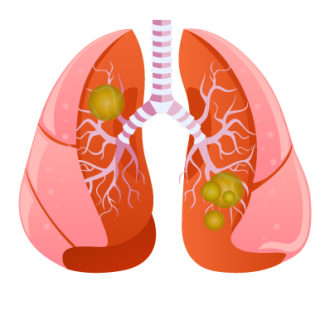 Пневмония без температуры &mdash; симптомы, признаки и лечение