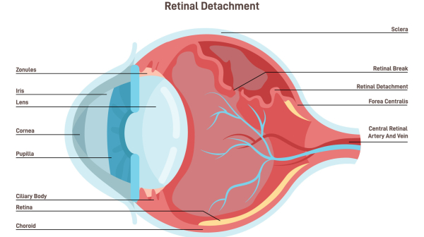 Препарат против эректильной дисфункции повышал риск серозной отслойки сетчатки Препарат против эректильной дисфункции повышал риск серозной отслойки сетчатки